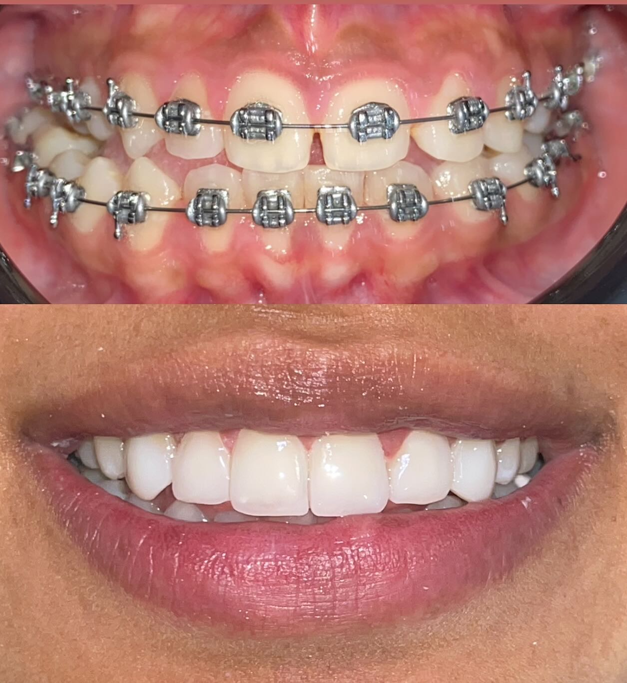 Antes y después paciente 1