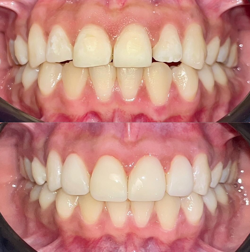 Antes y después paciente 2