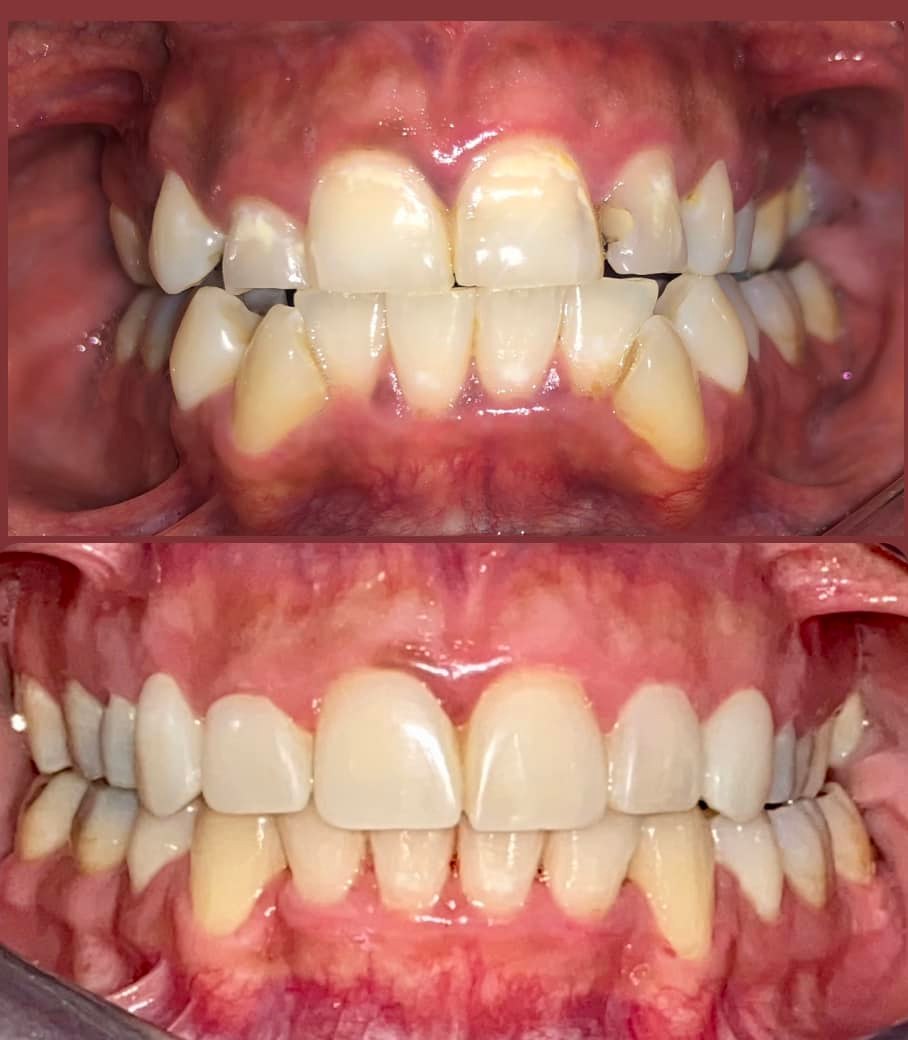 Antes y después paciente 3